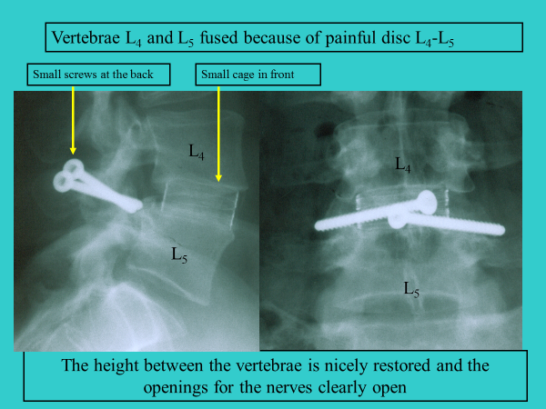 The wear and tear of the discs can lead to the following: