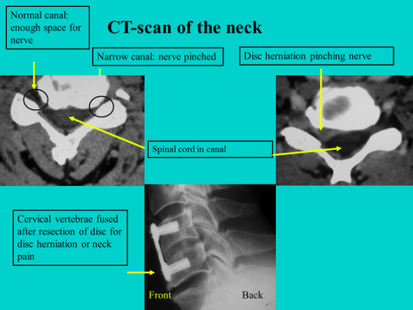 Dull NECKPAIN due to wear and tear of the discs